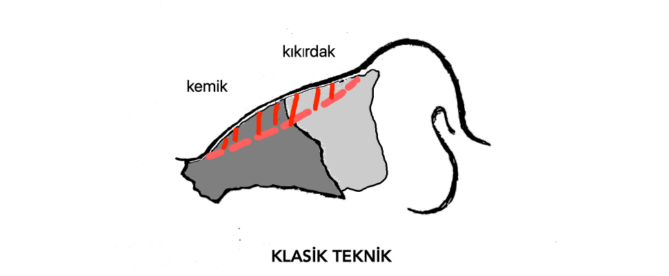 klasik-teknikler
